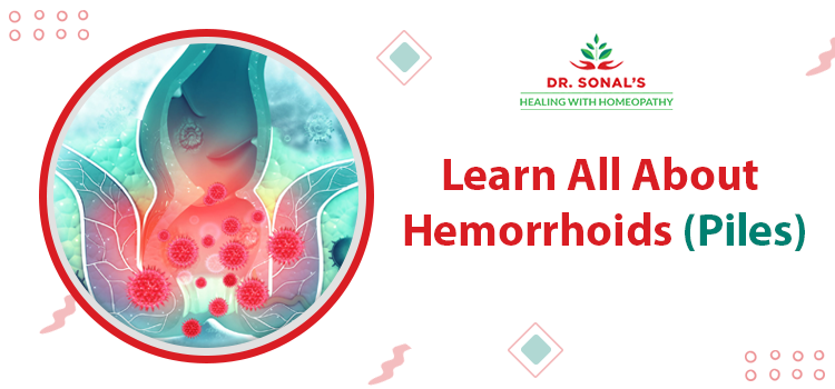 Learn All About Hemorrhoids (Piles)